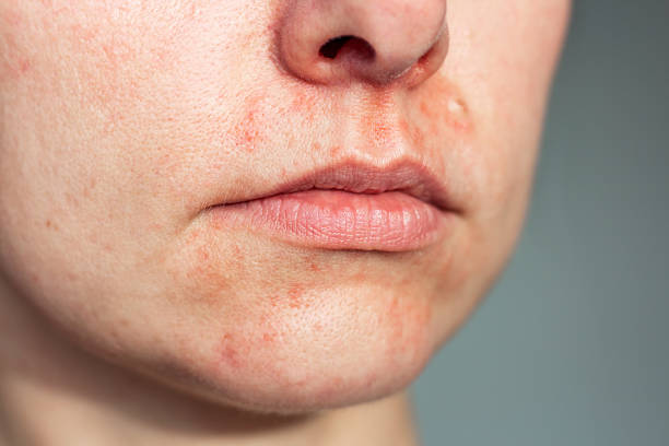 Not Every Breakout Is Acne